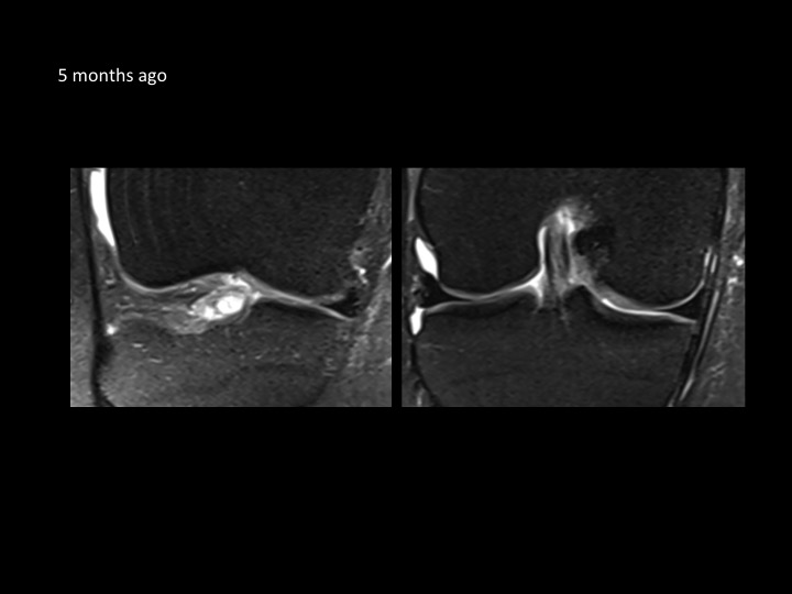 Figure 5 for case anterior cruciate ligament ( RID2781 )